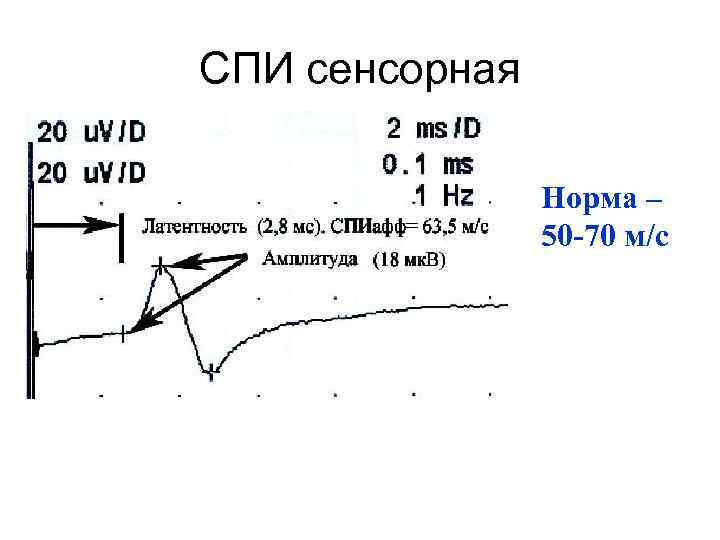 СПИ сенсорная Норма – 50 -70 м/с 