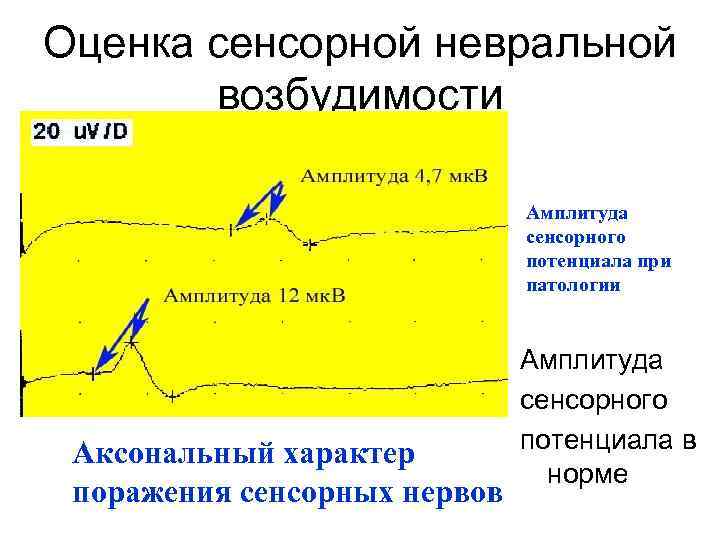 Оценка сенсорной невральной возбудимости Амплитуда сенсорного потенциала при патологии Аксональный характер поражения сенсорных нервов