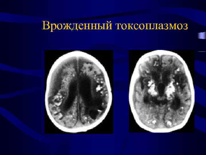 Врожденный токсоплазмоз 