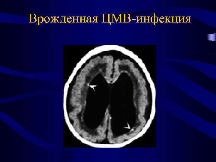 Врожденная ЦМВ-инфекция 
