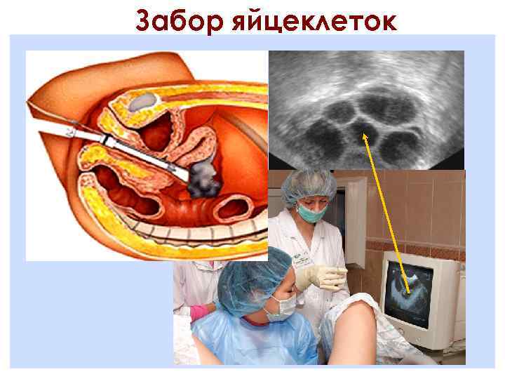 Забор яйцеклеток 