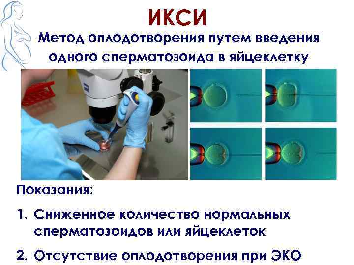 ИКСИ Метод оплодотворения путем введения одного сперматозоида в яйцеклетку Показания: 1. Сниженное количество нормальных