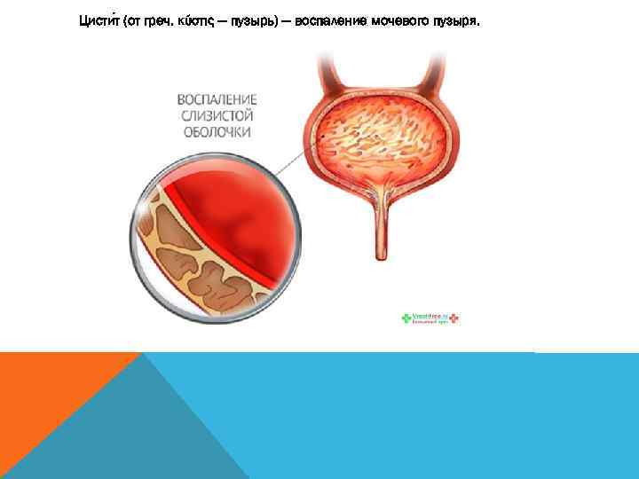 Цисти т (от греч. κύστις — пузырь) — воспаление мочевого пузыря. 