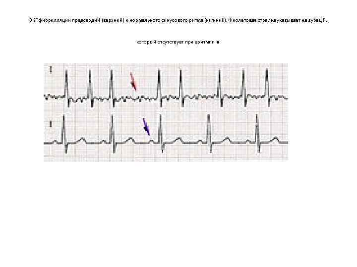 ЭКГ фибрилляции предсердий (верхний) и нормального синусового ритма (нижний). Фиолетовая стрелка указывает на зубец
