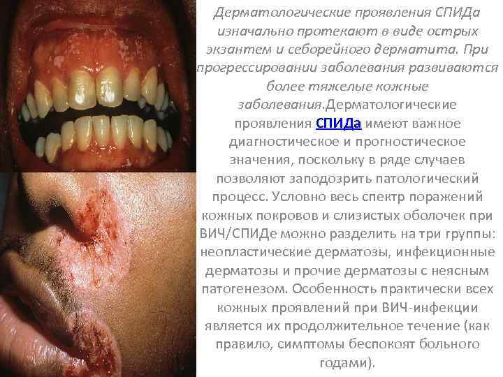 Дерматологические проявления СПИДа изначально протекают в виде острых экзантем и себорейного дерматита. При прогрессировании