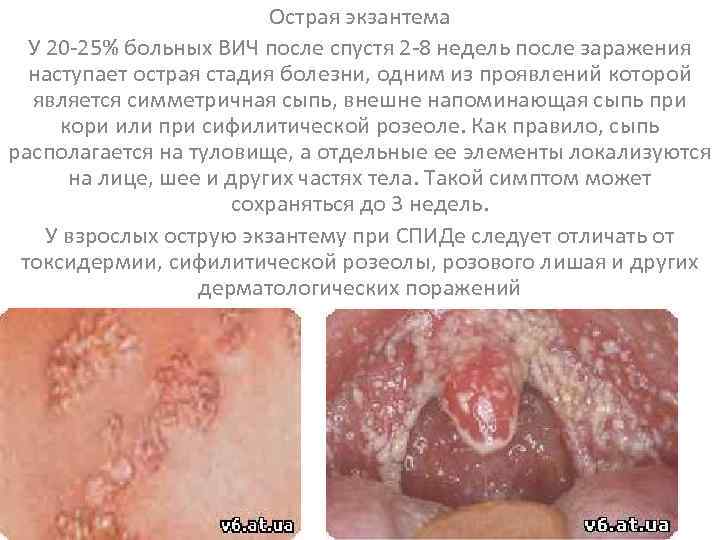 Острая экзантема У 20 -25% больных ВИЧ после спустя 2 -8 недель после заражения