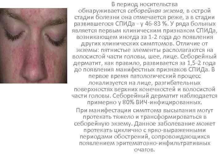 В период носительства обнаруживается себорейная экзема, в острой стадии болезни она отмечается реже, а