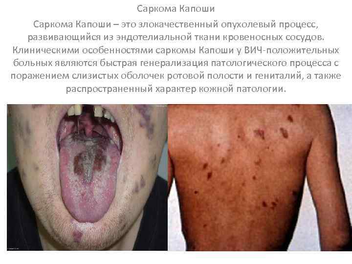 Саркома Капоши – это злокачественный опухолевый процесс, развивающийся из эндотелиальной ткани кровеносных сосудов. Клиническими