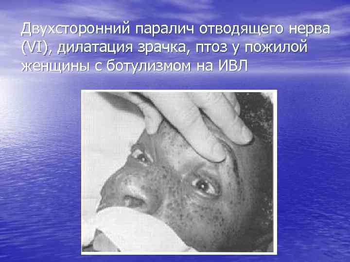 Двухсторонний паралич отводящего нерва (VI), дилатация зрачка, птоз у пожилой женщины с ботулизмом на