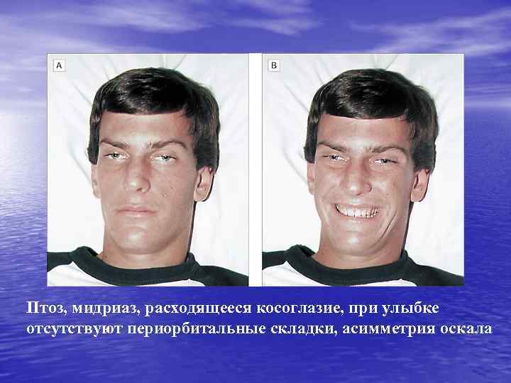 Птоз, мидриаз, расходящееся косоглазие, при улыбке отсутствуют периорбитальные складки, асимметрия оскала 