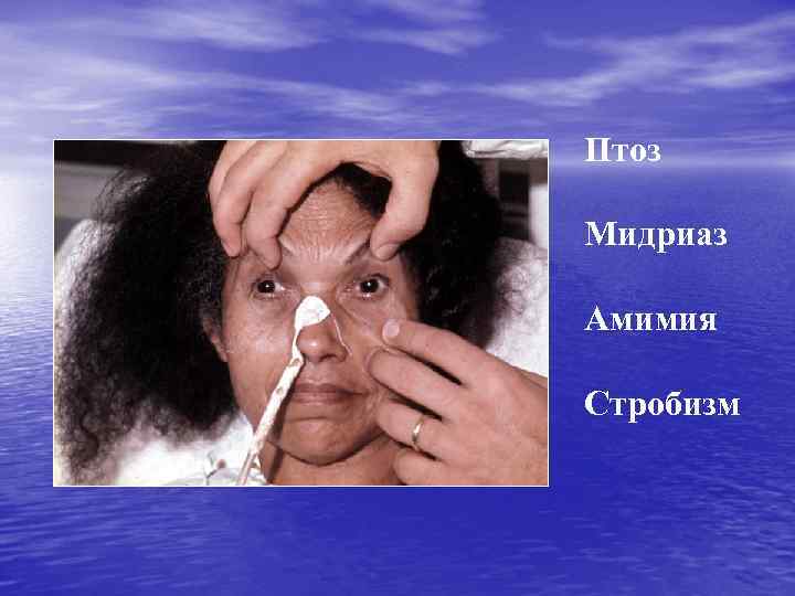 Птоз Мидриаз Амимия Стробизм 
