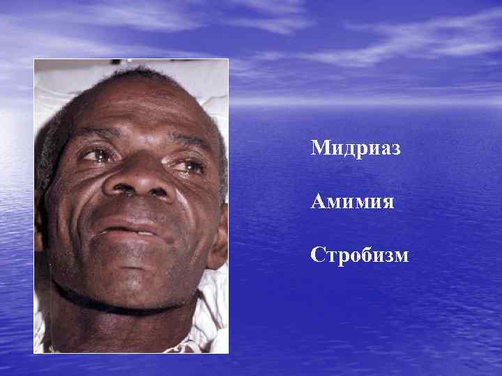 Мидриаз Амимия Стробизм 