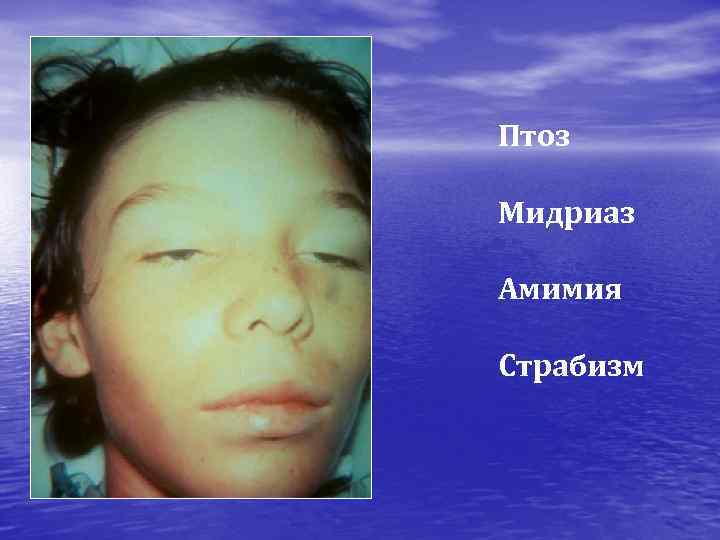 Птоз Мидриаз Амимия Страбизм 