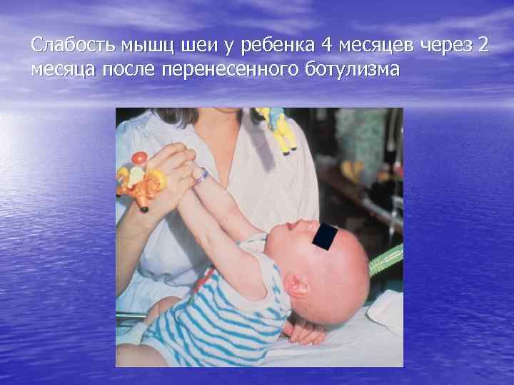 Слабость мышц шеи у ребенка 4 месяцев через 2 месяца после перенесенного ботулизма 