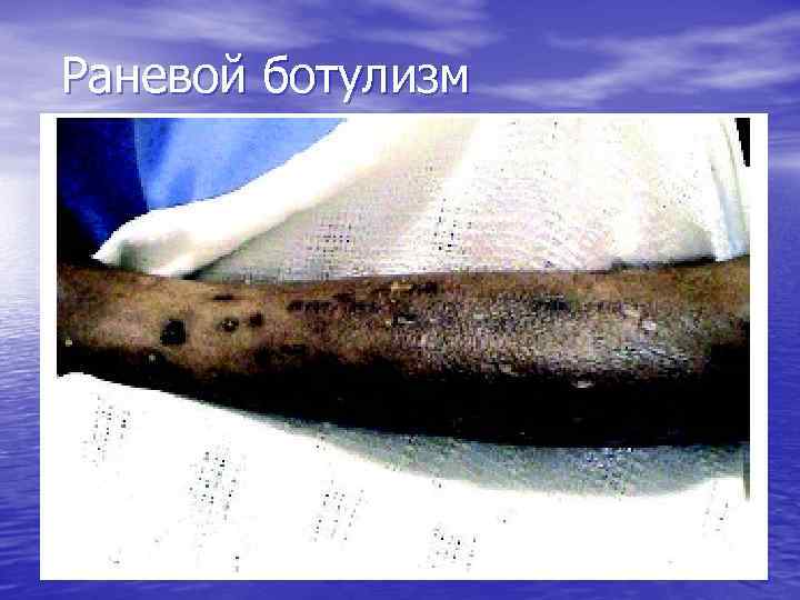 Раневой ботулизм 