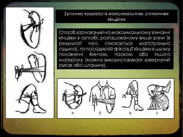 Зупинка кровотечі максимальним згинанням кінцівок Спосіб заснований на максимальному згинанні кінцівки в суглобі, розташованому