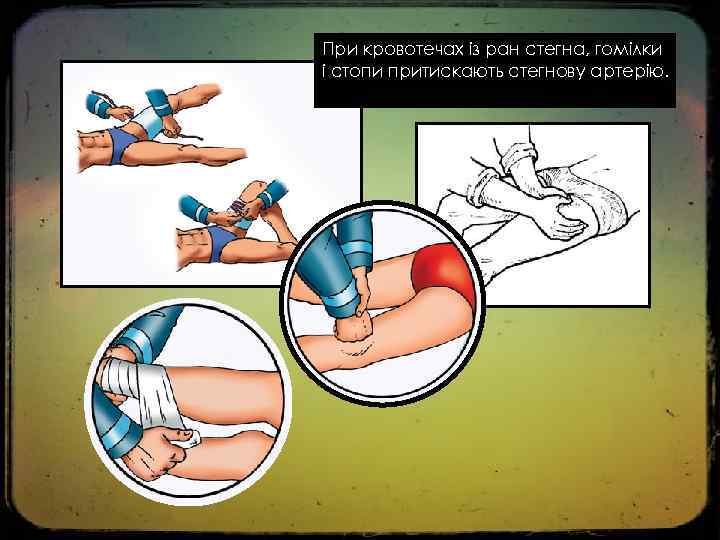 При кровотечах із ран стегна, гомілки і стопи притискають стегнову артерію. 