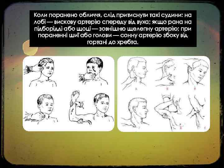 Коли поранено обличчя, слід притиснути такі судини: на лобі — вискову артерію спереду від