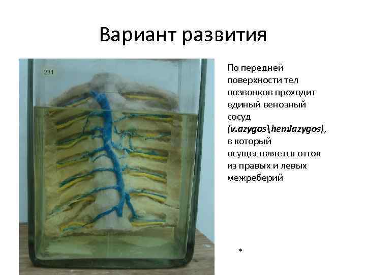 Вариант развития По передней поверхности тел позвонков проходит единый венозный сосуд (v. azygoshemiazygos), в