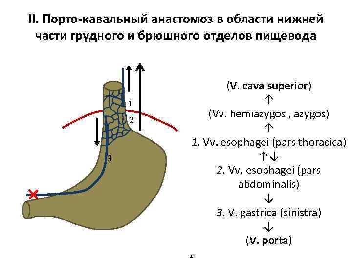 II. Порто-кавальный анастомоз в области нижней части грудного и брюшного отделов пищевода 1 2