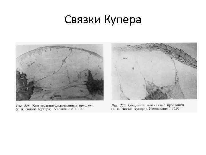 Связки Купера 