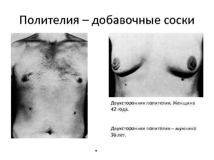 Полителия – добавочные соски Двухсторонняя полителия. Женщина 42 года. Двухсторонняя полителия – мужчина 36