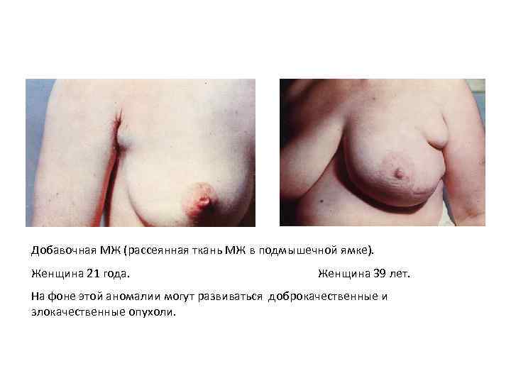 Добавочная МЖ (рассеянная ткань МЖ в подмышечной ямке). Женщина 21 года. Женщина 39 лет.