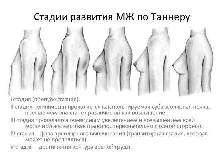 Стадии развития МЖ по Таннеру I стадия (препубертатная). II стадия клинически проявляется как пальпируемая