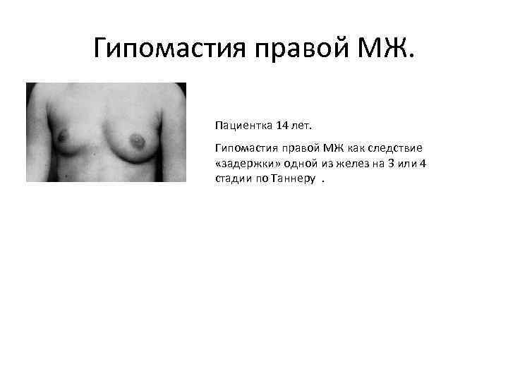 Гипомастия правой МЖ. Пациентка 14 лет. Гипомастия правой МЖ как следствие «задержки» одной из