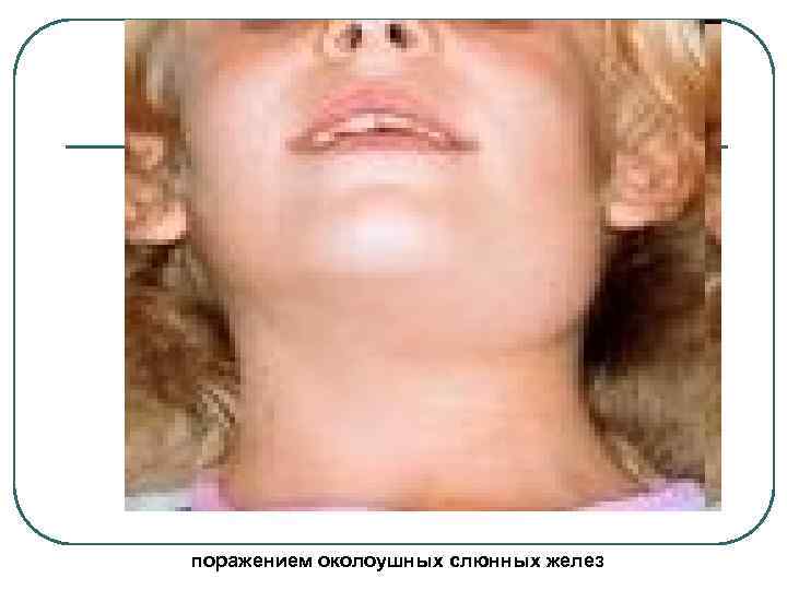 поражением околоушных слюнных желез 