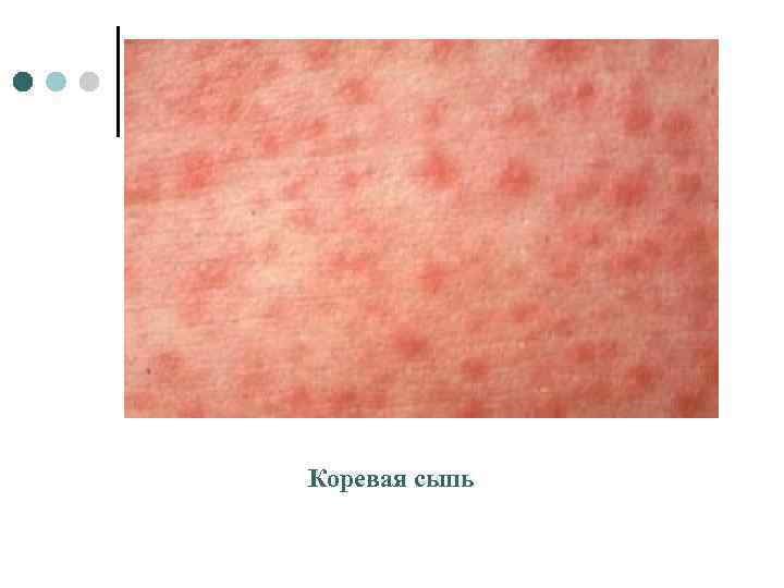 Коревая сыпь 