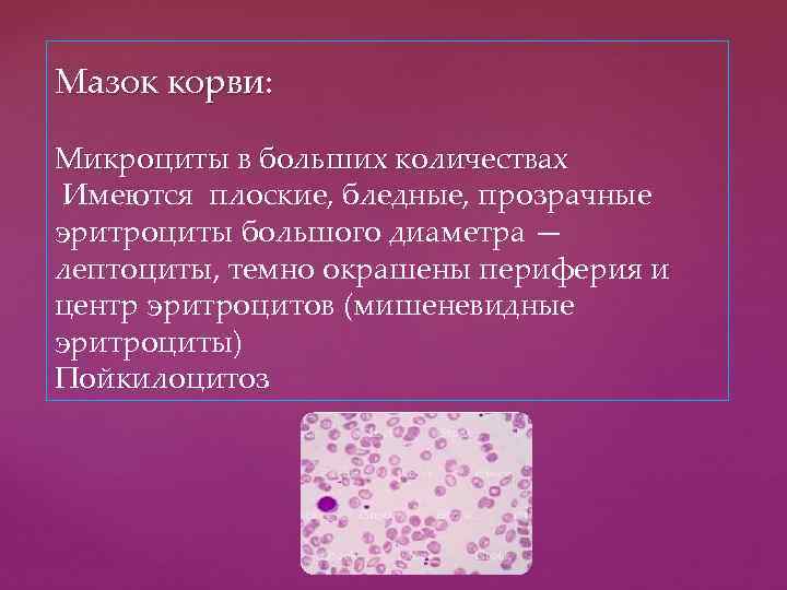 Мазок корви: Микроциты в больших количествах Имеются плоские, бледные, прозрачные эритроциты большого диаметра —