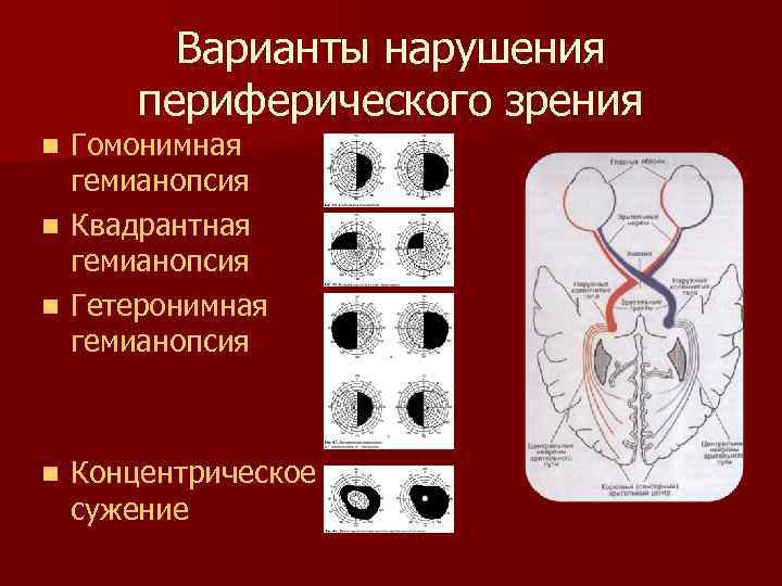 Варианты нарушения периферического зрения Гомонимная гемианопсия n Квадрантная гемианопсия n Гетеронимная гемианопсия n n