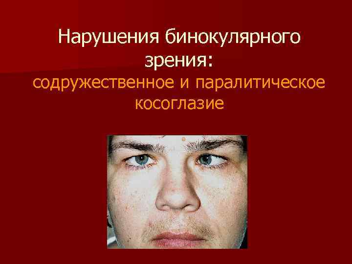 Нарушения бинокулярного зрения: содружественное и паралитическое косоглазие 