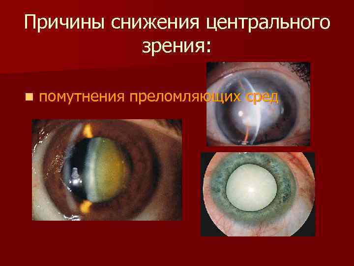 Причины снижения центрального зрения: n помутнения преломляющих сред 