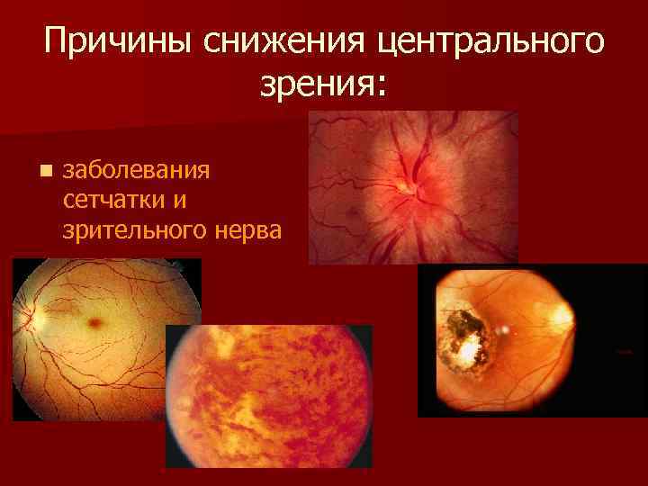Причины снижения центрального зрения: n заболевания сетчатки и зрительного нерва 