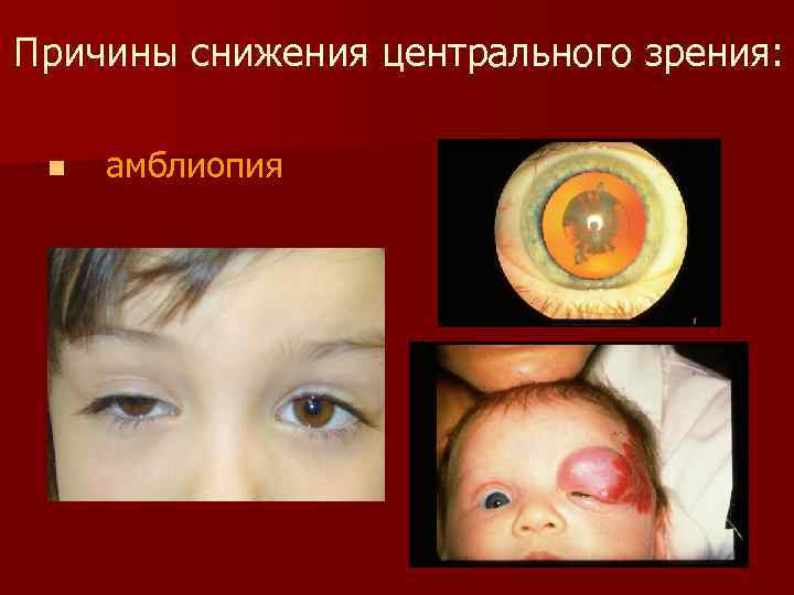 Причины снижения центрального зрения: n амблиопия 