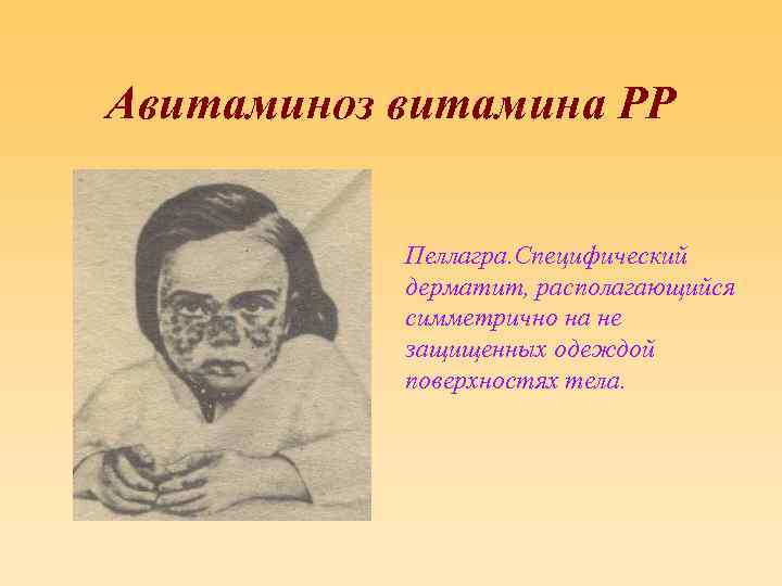 Авитаминоз витамина РР Пеллагра. Специфический дерматит, располагающийся симметрично на не защищенных одеждой поверхностях тела.