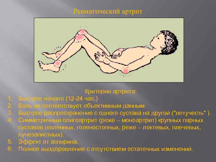 Ревматический артрит 1. 2. 3. 4. 5. 6. Критерии артрита: Быстрое начало (12 -24