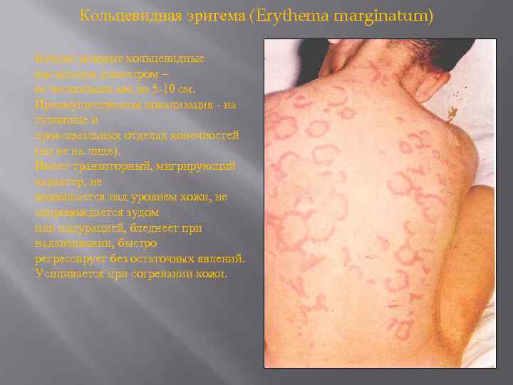 Кольцевидная эритема (Erythema marginatum) Бледно-розовые кольцевидные высыпания диаметром – от нескольких мм до 5