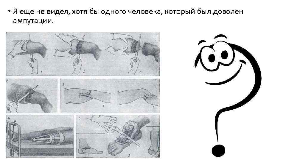  • Я еще не видел, хотя бы одного человека, который был доволен ампутации.