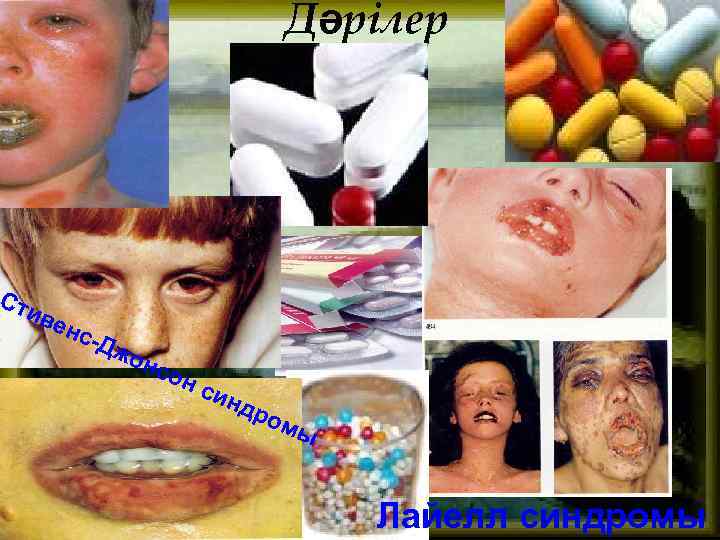 Сти Дәрілер вен с-Д жо нс инд ром ы Лайелл синдромы 