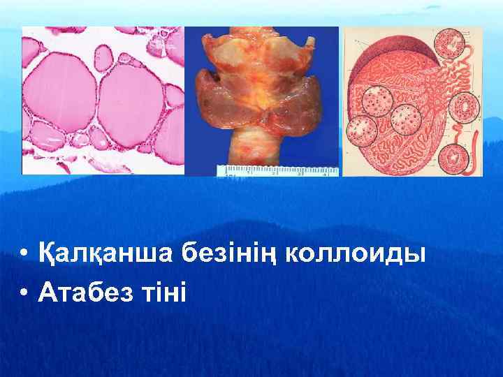  • Қалқанша безінің коллоиды • Атабез тіні 