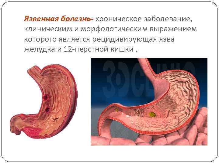 Язвенная болезнь- хроническое заболевание, клиническим и морфологическим выражением которого является рецидивирующая язва желудка и