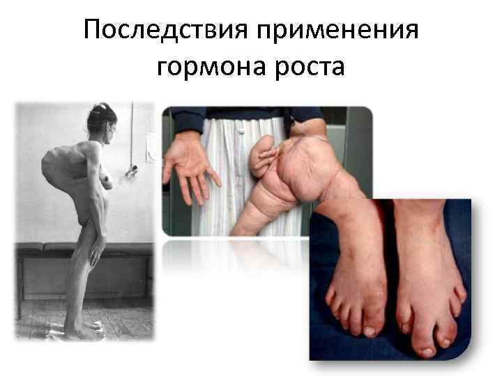 Последствия применения гормона роста 