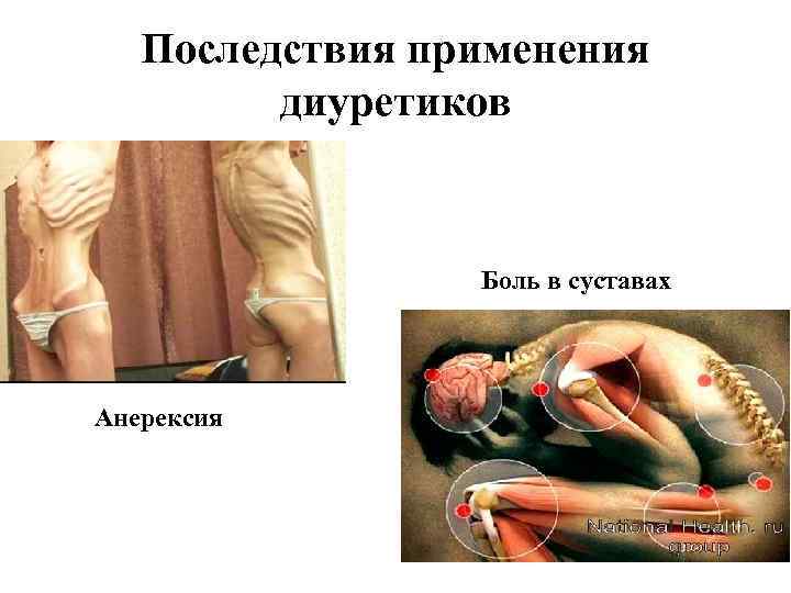 Последствия применения диуретиков Боль в суставах Анерексия 