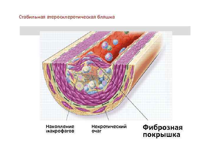 Стабильная атеросклеротическая бляшка. Атеросклеротическая бляшка микропрепарат. Фиброзную бляшку(петронилла). Фиброзная бляшка гистология.