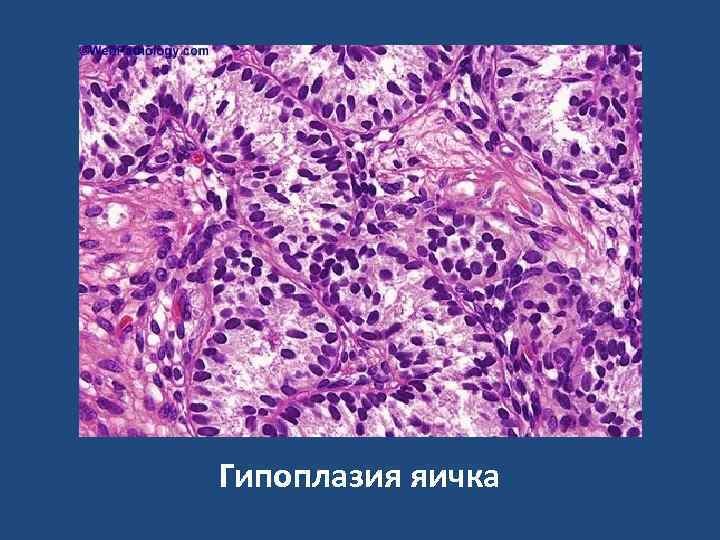 Гипоплазия яичка 