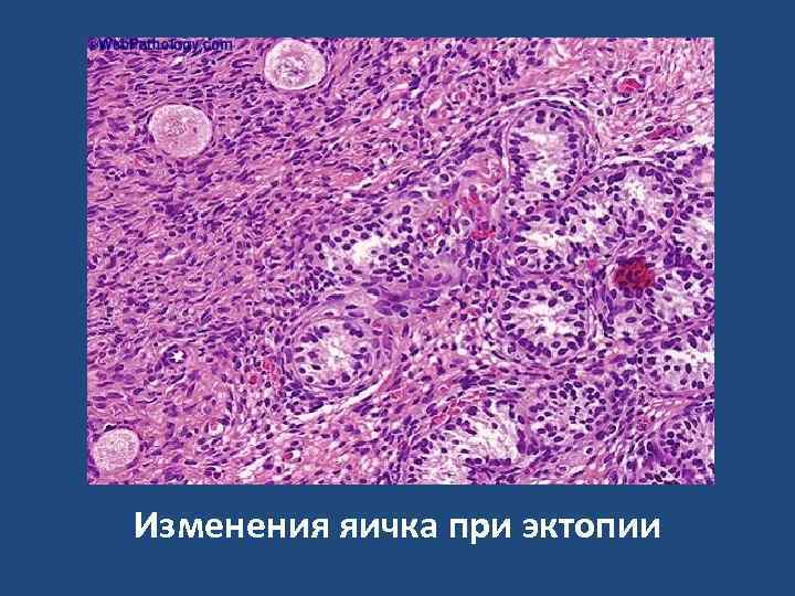 Изменения яичка при эктопии 