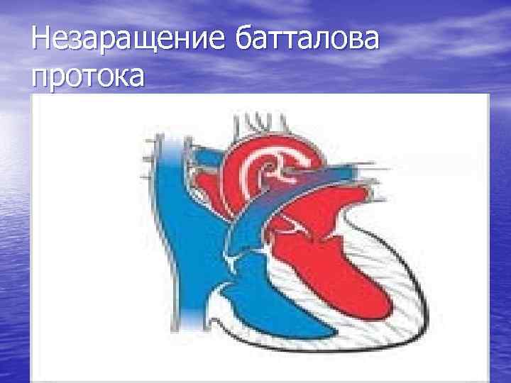 Незаращение батталова протока 